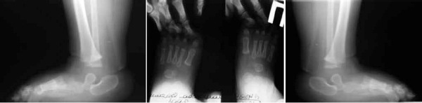 Рентгенограммы стоп в прямой и боковой проекциях с максимальной тыльной флексией: определяется ригидный вывих головки таранной костию