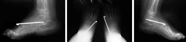 Рентгенография стоп после операции в двух проекциях: определяется вправление таранно-ладьевидного сустава, который фиксирован спицей Киршнера с двух сторон.