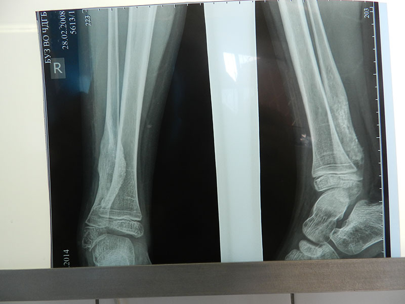 Рентгенография через 1 год после операции
