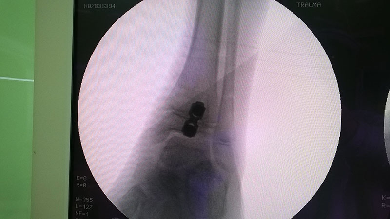рентгенография прямая после операции