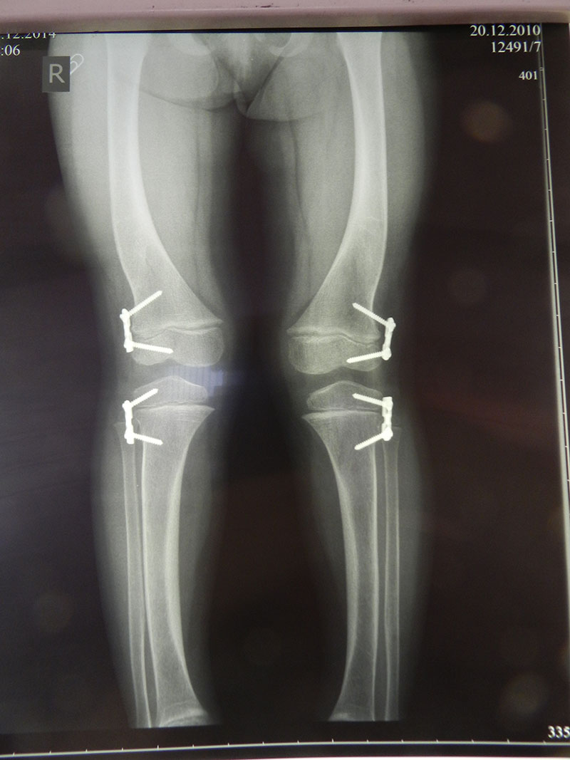 рентгенография прямая перед удалением пластин