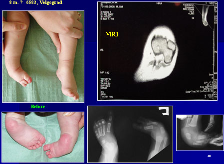 Малоберцовая гемимелия правой стопы, Аплазия IV и V лучей стопы справа после лечения.